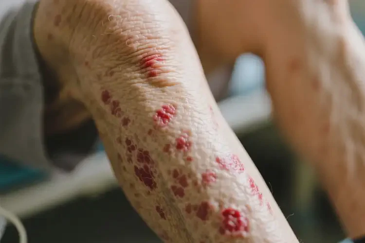 老人大腿有湿疹可不可以根治(图4)