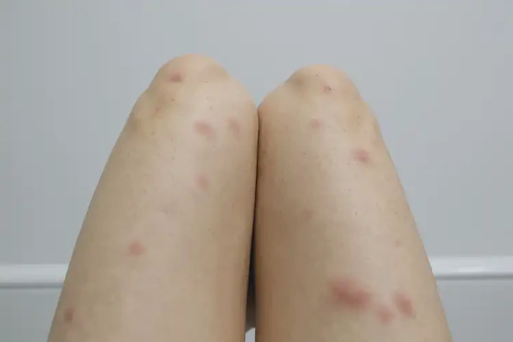 青少年大腿上偶爾起濕疹不管它會自己痊愈嗎(圖4)