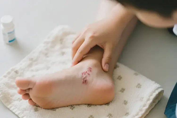 中學生腳上長濕疹可不可以根治(圖2)