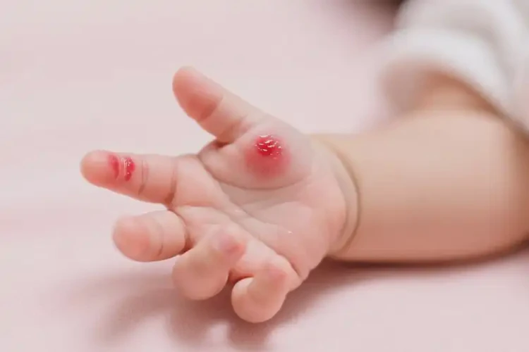 嬰兒手上偶爾長(zhǎng)濕疹可不可以根治(圖1)