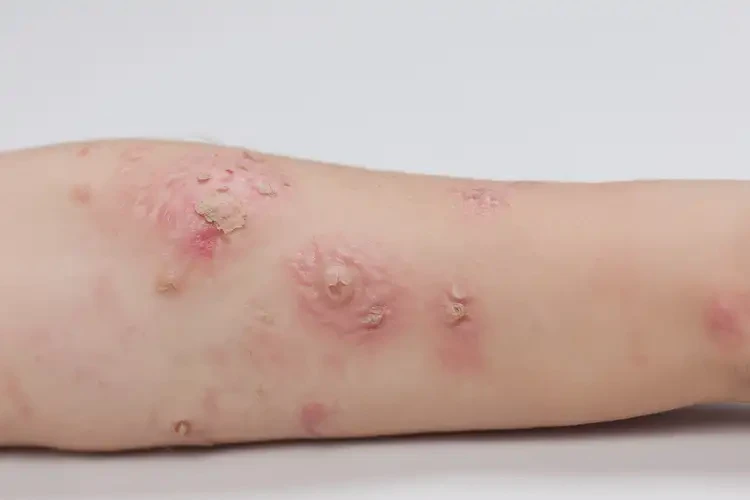 孩子手臂長濕疹不管它會自己自愈嗎(圖3)