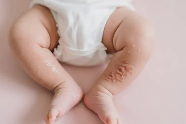 新生兒小腿上出濕疹可不可以根治(圖1)