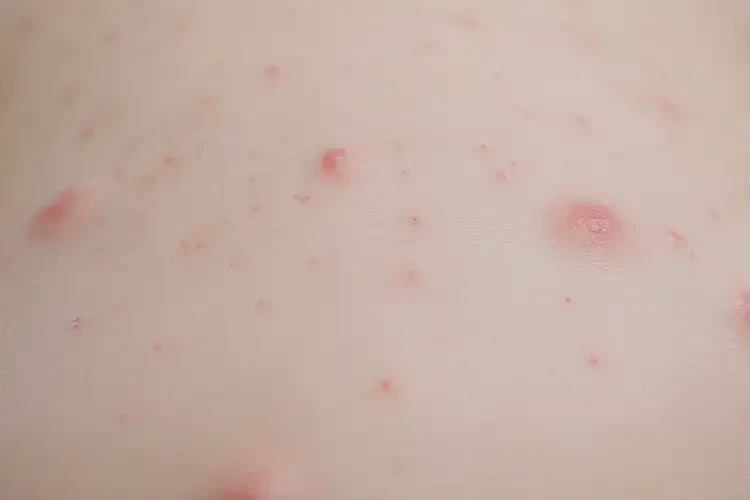 寶寶身上偶爾起濕疹可不可以根治(圖4)