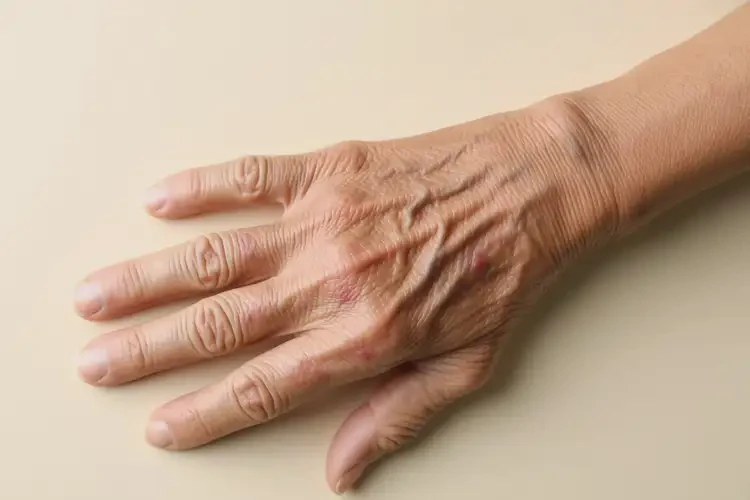老年人手上有濕疹能徹底自愈嗎(圖4)