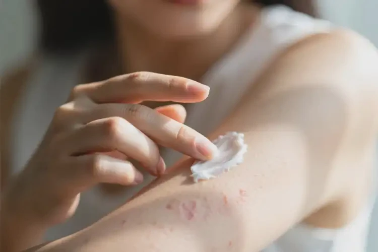 女人手臂容易起濕疹能不能根治(圖2)