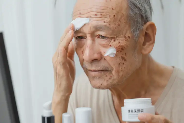 老年人面部有濕疹可不可以徹底自愈(圖3)