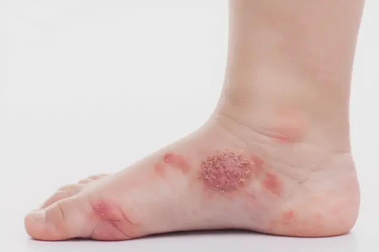 孩子腳上偶爾起濕疹不管它會自己自愈嗎(圖3)