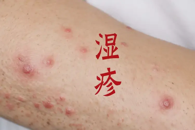 女生全身偶爾起濕疹可不可以根治(圖4)