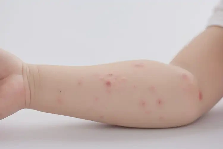 少兒手臂上偶爾長(zhǎng)濕疹能徹底自愈嗎(圖4)