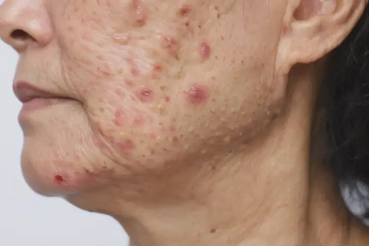 女性脖子上容易起濕疹可不可以根治(圖4)