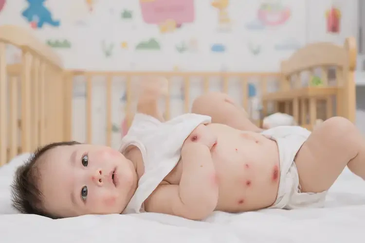 孩子肚子有濕疹可以徹底自愈嗎(圖4)