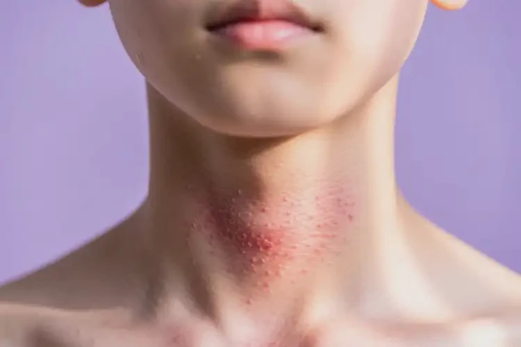 青少年脖子上容易起濕疹可不可以根治(圖3)