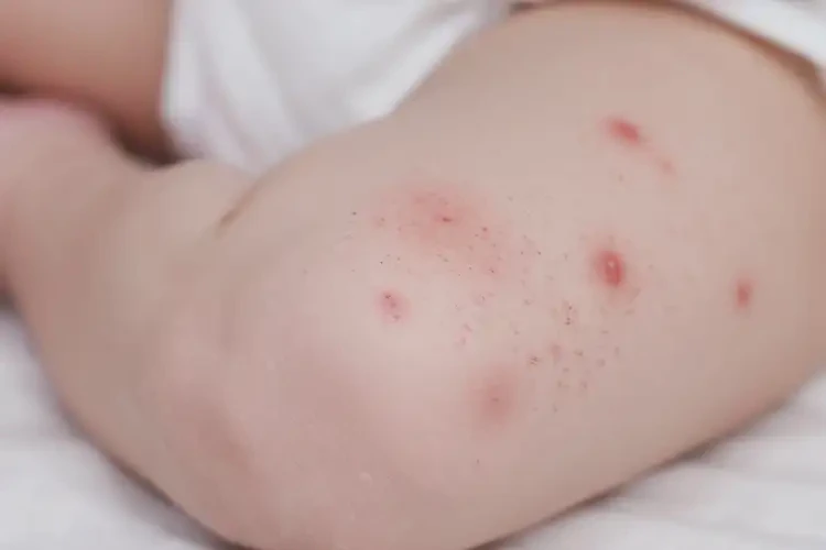 新生兒大腿上容易長濕疹可不可以根治(圖4)
