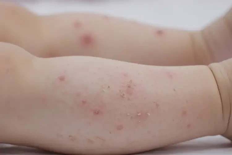 少兒四肢偶爾起濕疹不管它會(huì)自己自愈嗎(圖4)