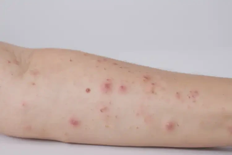 女生手臂上有濕疹可以徹底自愈嗎(圖3)