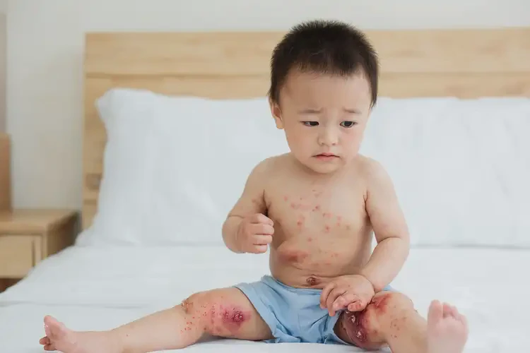 小兒大腿上經(jīng)常長濕疹不管它會自己好嗎(圖4)