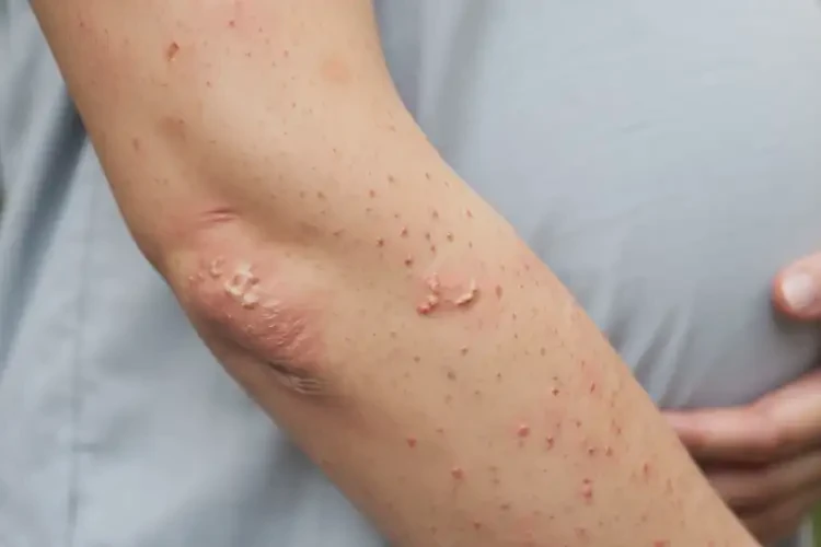 孕婦手臂經常長濕疹可以徹底自愈嗎(圖4)