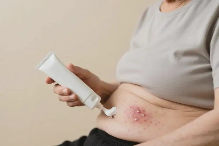 老年人肚子上經(jīng)常起濕疹可不可以徹底自愈(圖3)