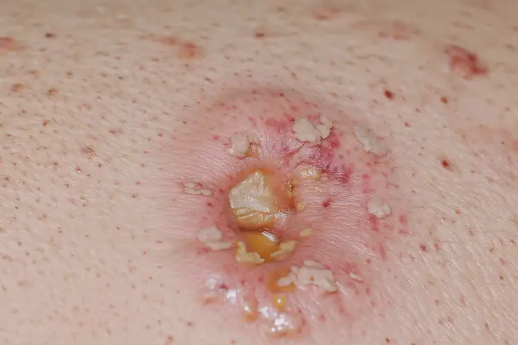 男人身上起湿疹能彻底自愈吗(图3)