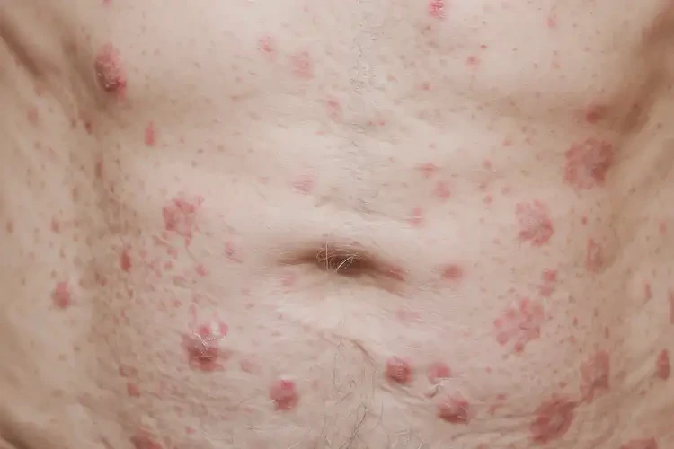 高齡老人肚子經(jīng)常起濕疹能夠徹底治愈嗎(圖4)