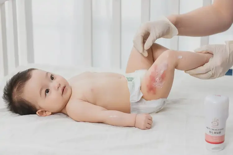 嬰兒大腿偶爾起濕疹可不可以根治(圖3)