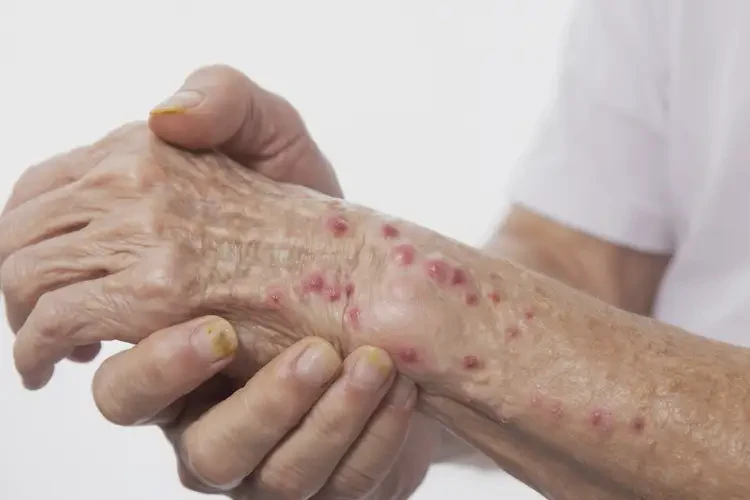 高齡老人手臂上經(jīng)常起濕疹能不能根治(圖3)