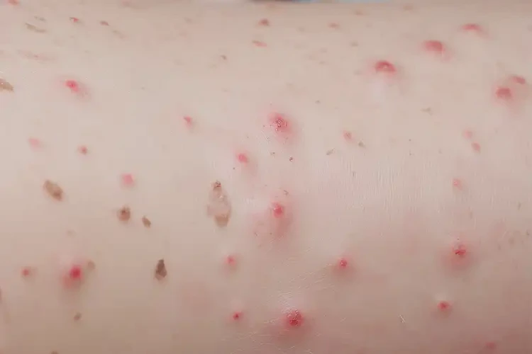 寶寶四肢起濕疹可不可以根治(圖4)