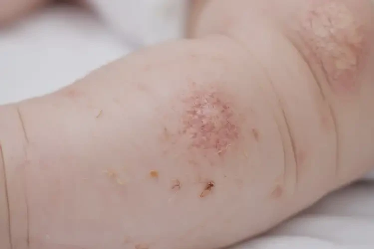 寶寶小腿上出現(xiàn)濕疹可不可以根治(圖4)