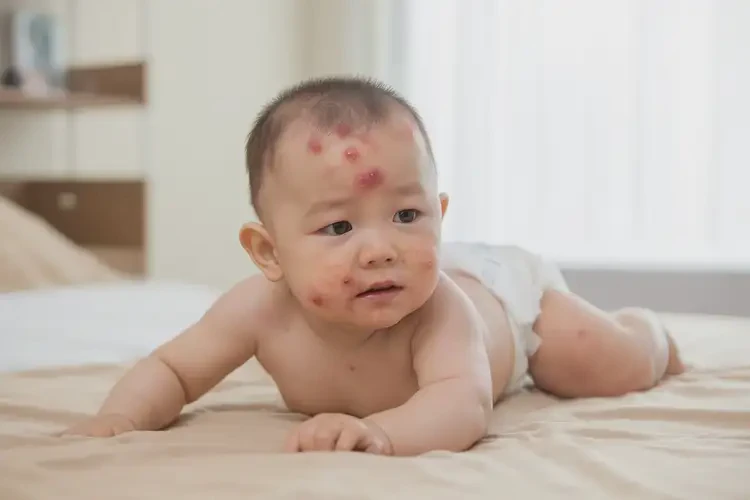 嬰幼兒屁股上容易長濕疹可以徹底自愈嗎(圖2)