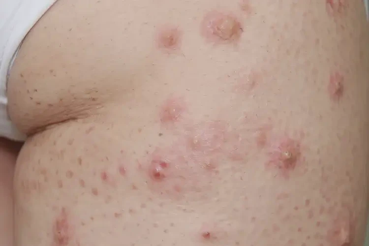 女生肛周長濕疹不管它會自己痊愈嗎(圖4)