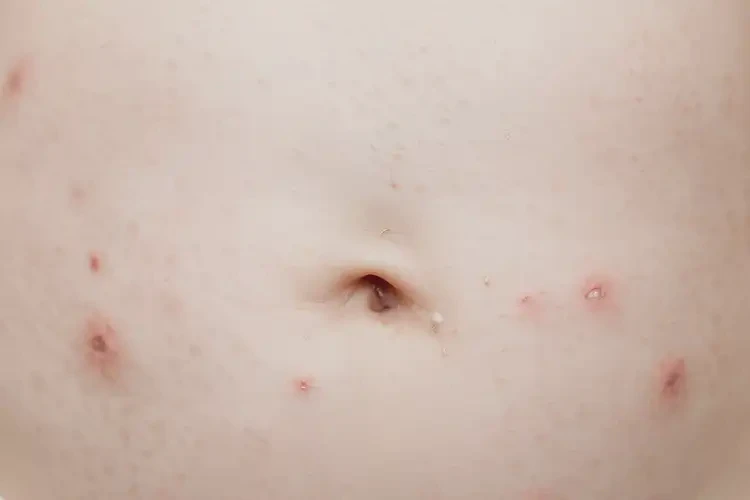 嬰幼兒肚子上偶爾長(zhǎng)濕疹能靠自己自愈嗎(圖4)