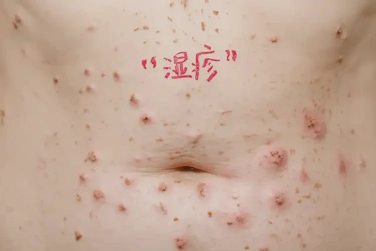 女人肚子上長(zhǎng)濕疹能不能根治(圖4)