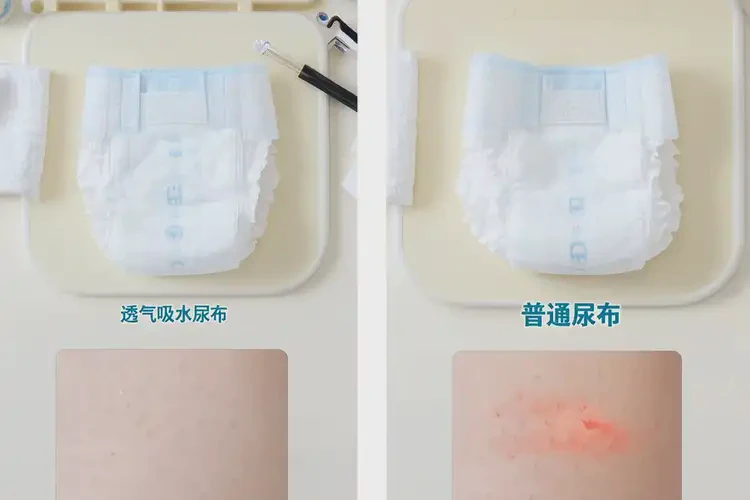 嬰幼兒肛周經(jīng)常長濕疹可不可以根治(圖2)