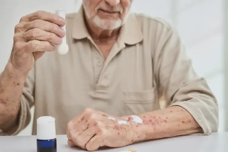 高齡老人手臂上出濕疹能不能根治(圖2)