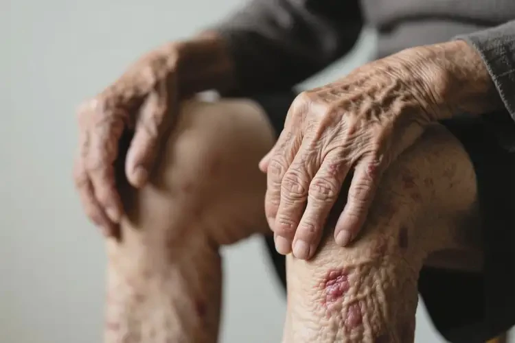 高齡老人四肢經(jīng)常起濕疹能不能根治(圖1)