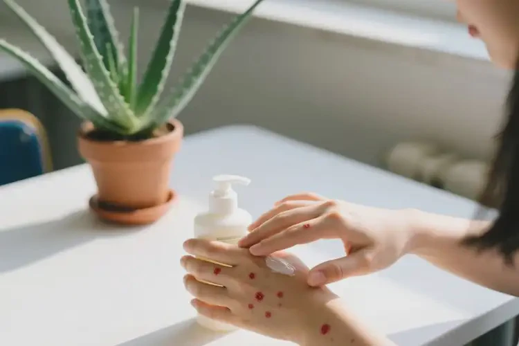 大学生手上经常起湿疹能不能彻底自愈(图4)