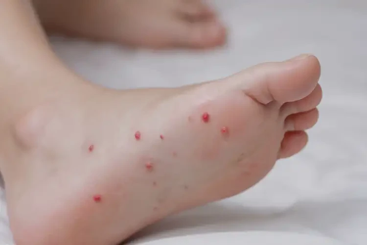 孩子腳上偶爾長濕疹可不可以根治(圖4)
