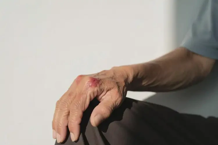 老人身上有濕疹可不可以根治(圖2)