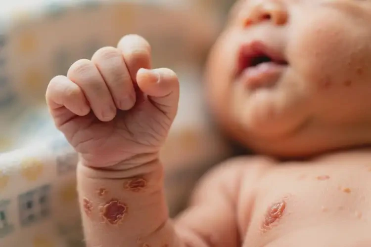 新生兒手臂偶爾起濕疹可不可以根治(圖1)