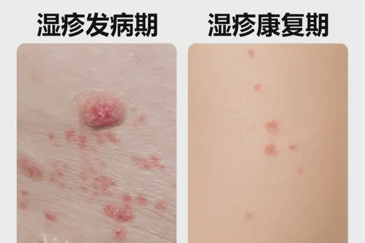 小學生肚子偶爾起濕疹能徹底自愈嗎(圖3)