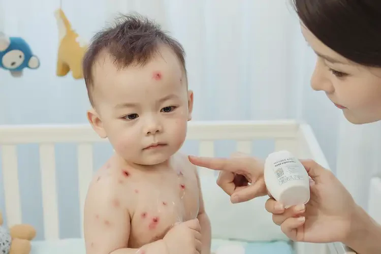 寶寶全身出濕疹可不可以根治(圖3)