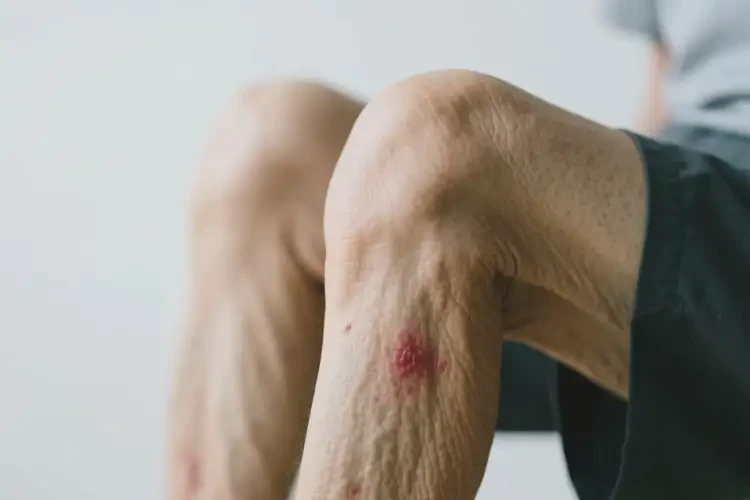 老人大腿偶爾起濕疹可不可以根治(圖4)