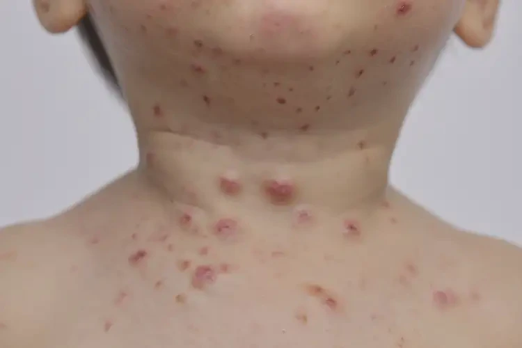 幼兒脖子有濕疹不管它會自己好嗎(圖3)