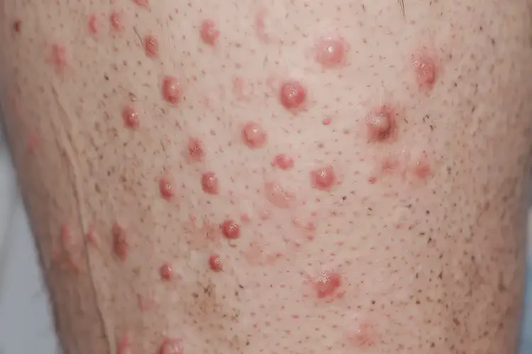 男生大腿容易長濕疹能徹底自愈嗎(圖4)