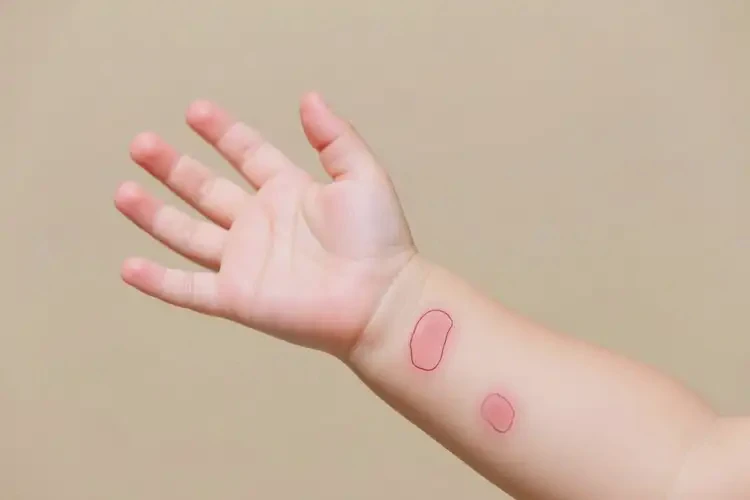 幼兒手臂上起濕疹能徹底自愈嗎(圖1)