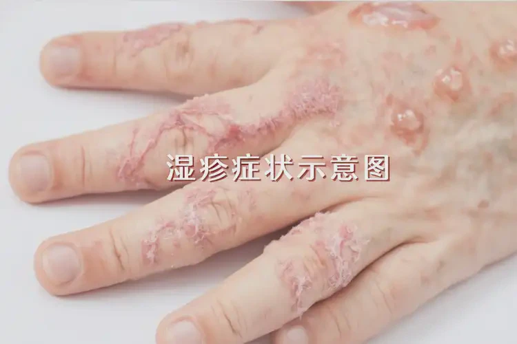 男人手上經(jīng)常長濕疹能不能根治(圖4)