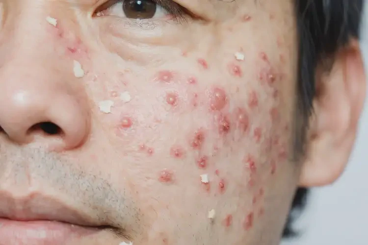 男人屁股偶爾長濕疹能不能徹底自愈(圖4)