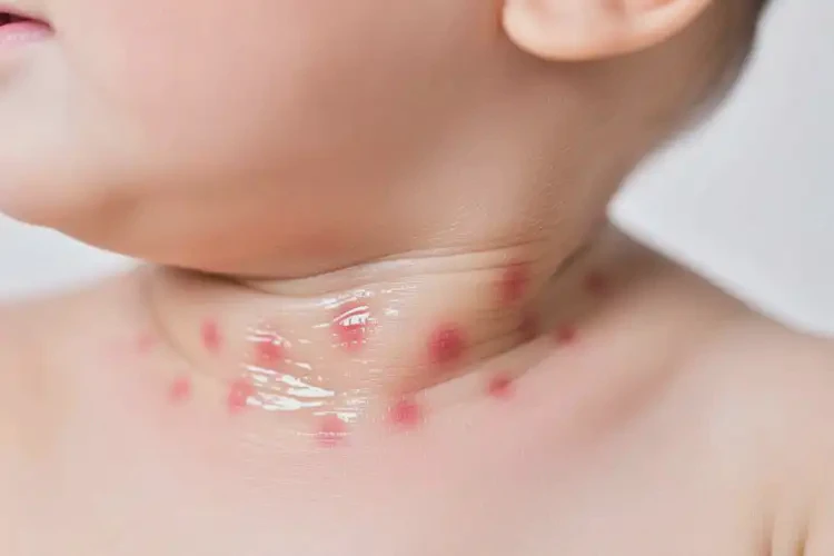 少兒脖子上偶爾長(zhǎng)濕疹能徹底自愈嗎(圖4)