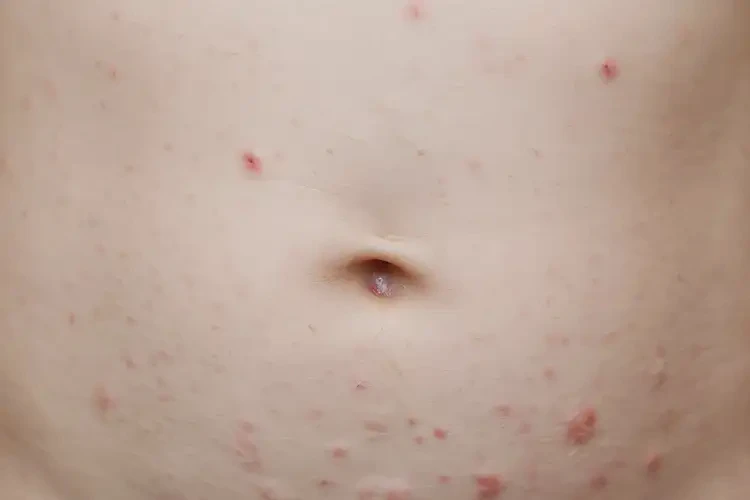 孩子肚子容易長濕疹能徹底自愈嗎(圖4)