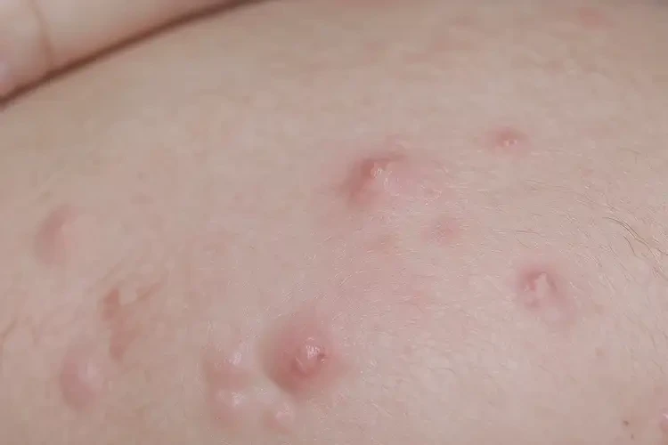 嬰兒肛周出現(xiàn)濕疹可不可以根治(圖4)
